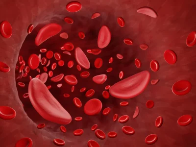 Anemia Falciforme: Sintomas, Tratamentos e Manejo da Qualidade de Vida