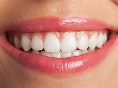 Clareamento Dental: Técnicas, Riscos e Benefícios